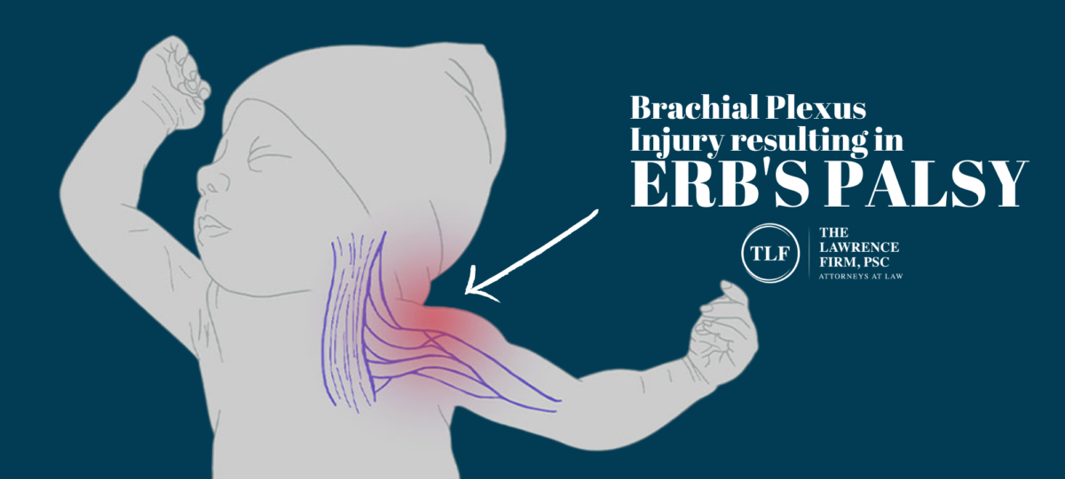 Brachial Plexus Injury resulting in erb's palsy_medical malpractice attorney