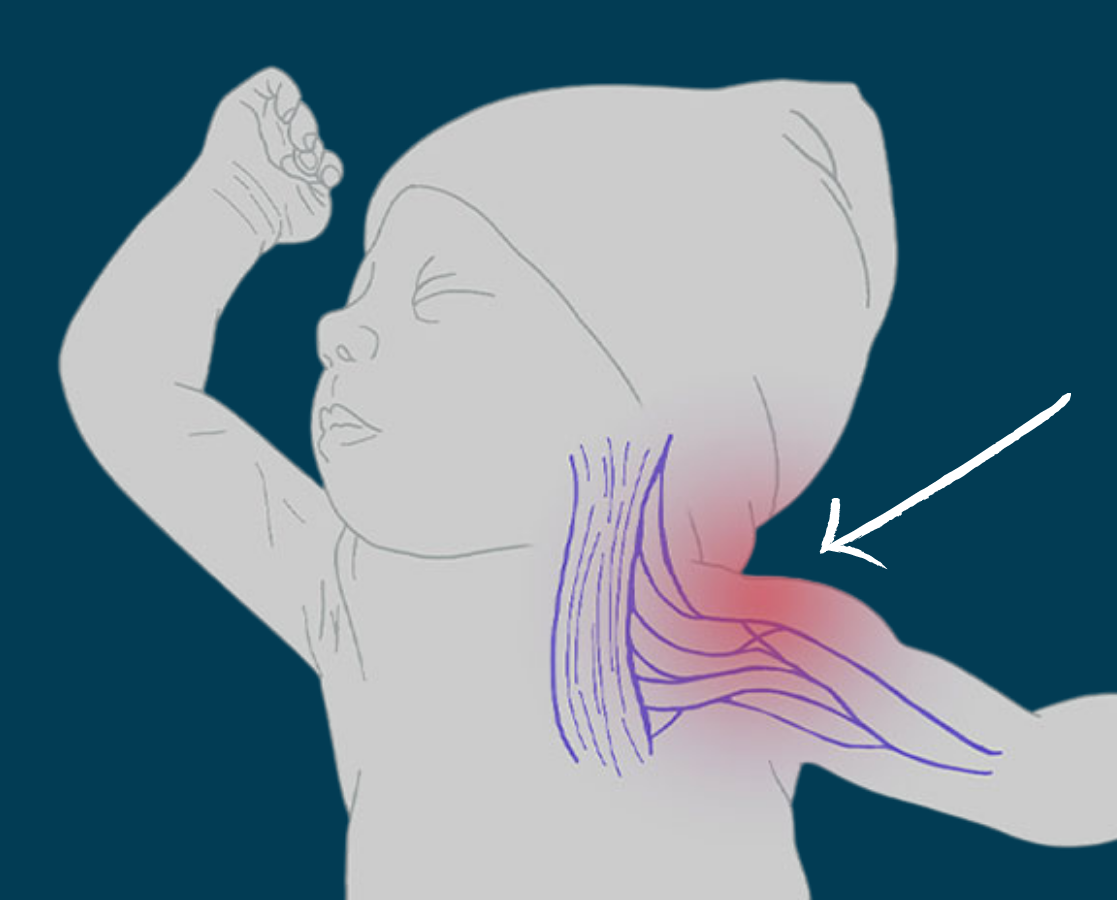 Brachial Plexus Injury resulting in erb's palsy_medical malpractice attorney