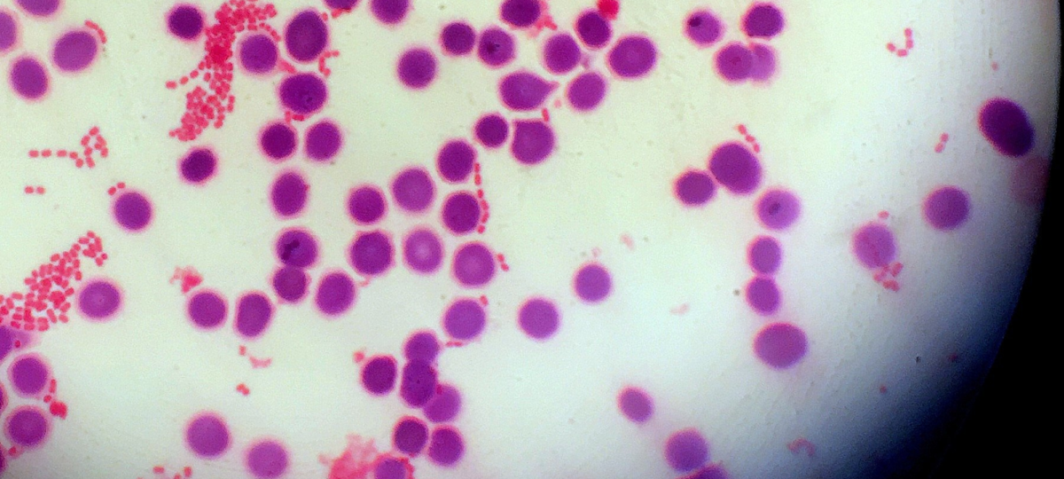 sepsis in the bloodstream_sepsis malpractice settlements