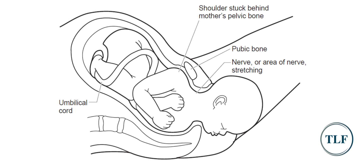 Shoulder Dystocia Birth Injury Lawyer in Ohio and Kentucky TLF