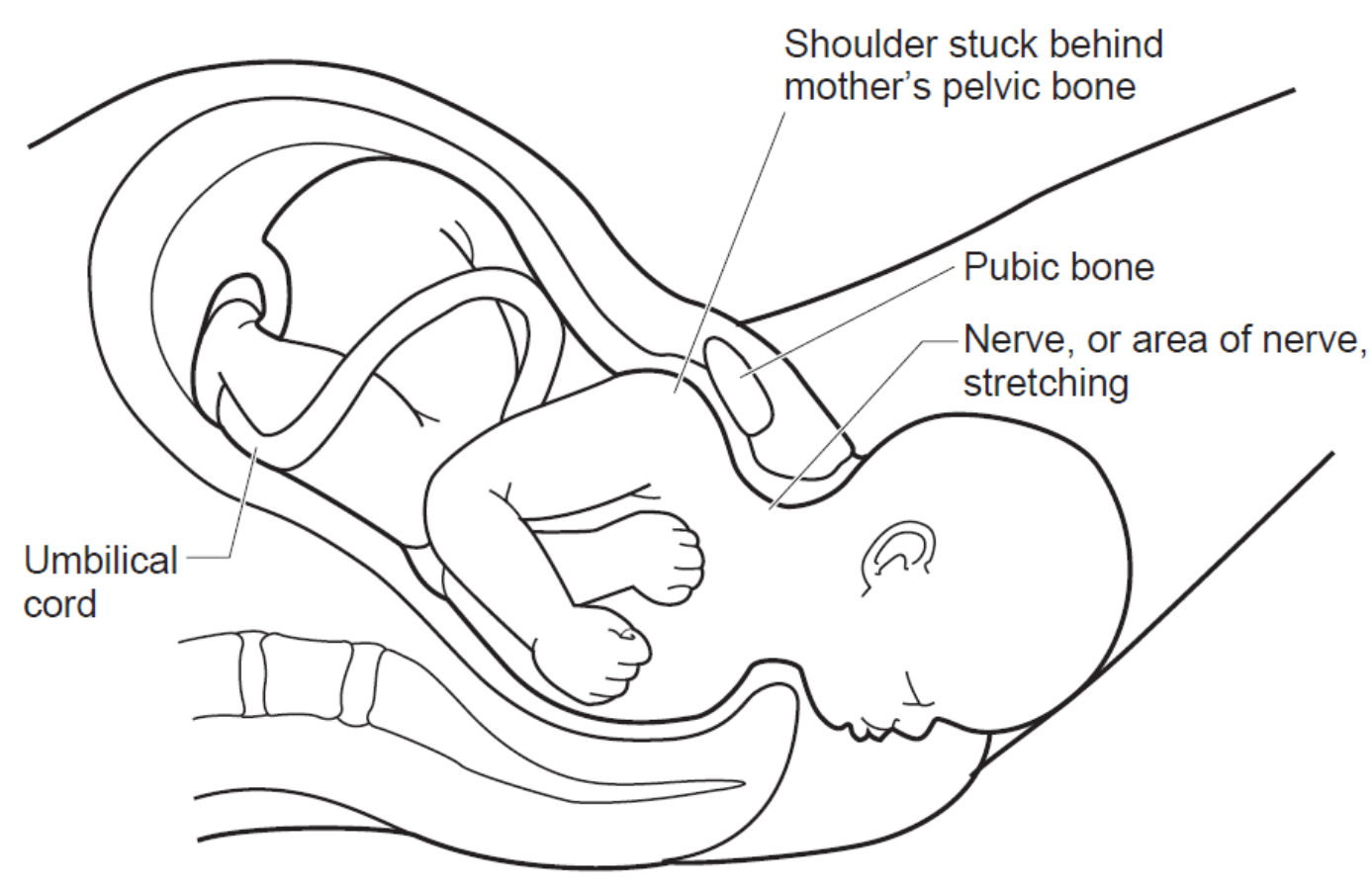 shoulder dystocia malpractice attorneys