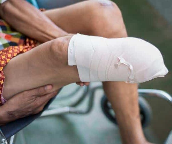 Kentucky Amputation Injury Lawyer