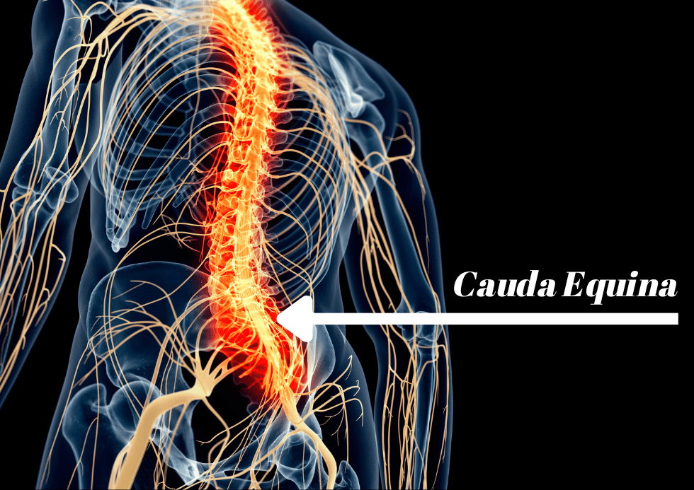 Cauda Equina Syndrome Malpractice