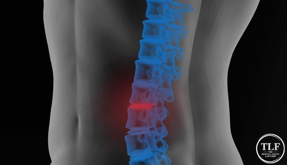 Conus Medullaris Syndrome