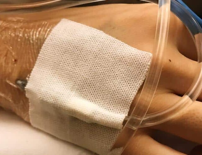 SIRS Systemic Inflammatory Response Syndrome