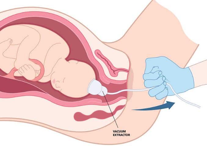 Vacuum Extraction Birth Injuries Attorney