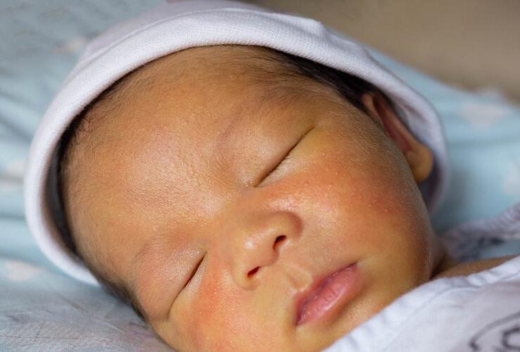 Failure to Diagnose Jaundice Lawyers