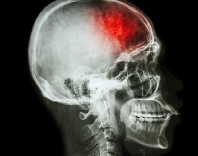 Failure to Treat a Stroke