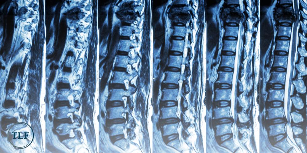 Medical Malpractice Spinal Cord Injuries