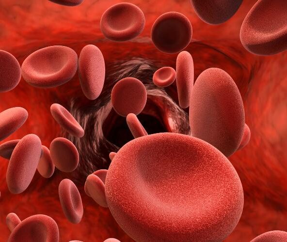 stroke malpractice settlements