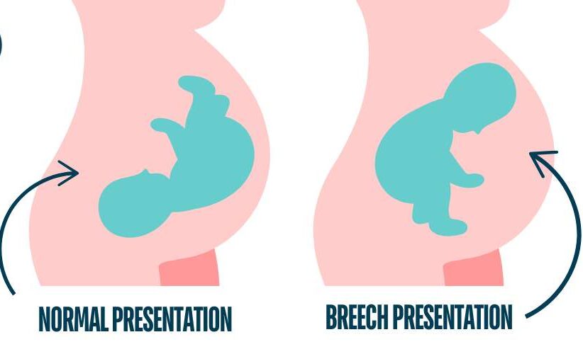 What is Breech Presentation