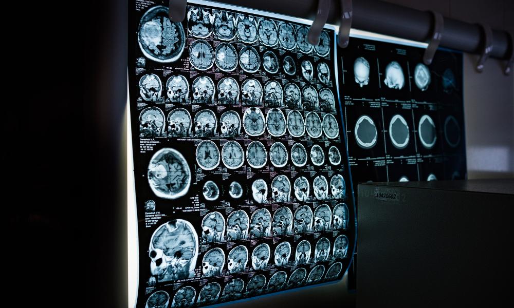 Wernicke's Encephalopathy Symptom