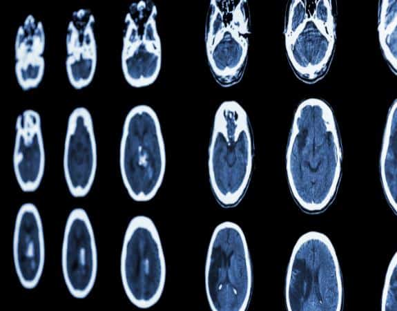 Hypoxic Ischemic Encephalopathy Stages