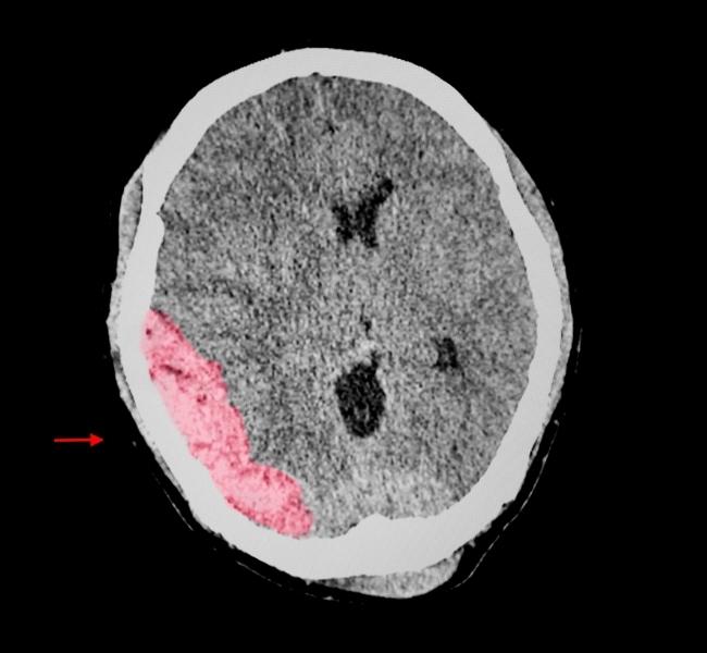 Kentucky Brain Injury Lawyer