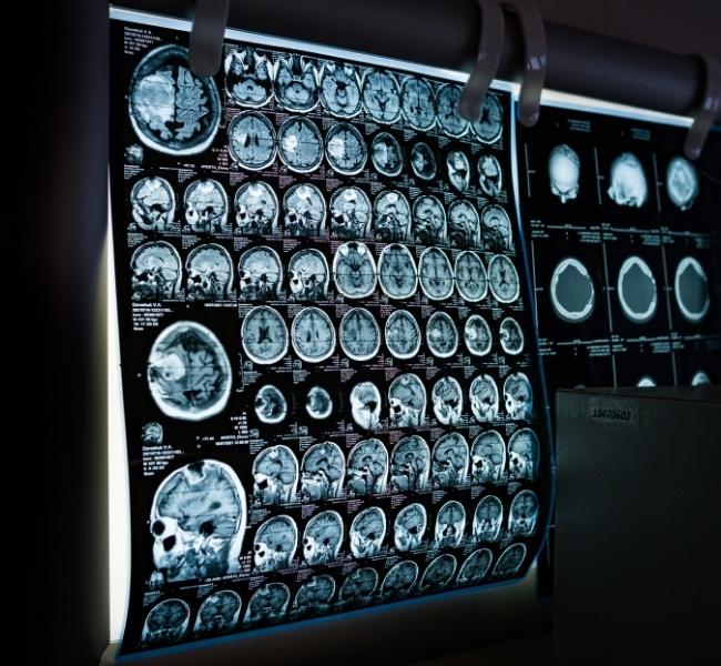 Ohio Brain Injury Attorney