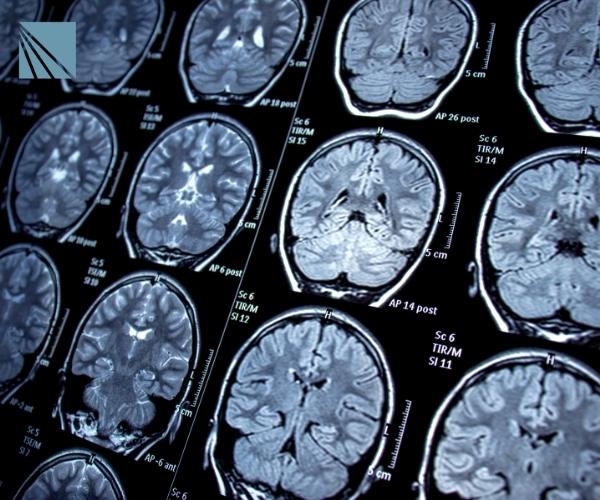 Ohio Neurology Malpractice Attorney